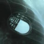 radiograph image of a pacemaker