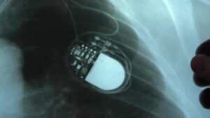 radiograph image of a pacemaker